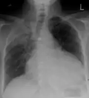 Pericardial effusion due to malignancy. Note bulbous heart and primary lung cancer in right upper lobe.
