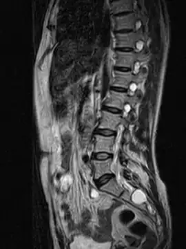 MRI sagittal image of sacral and dorso-lumbar perineural cysts.