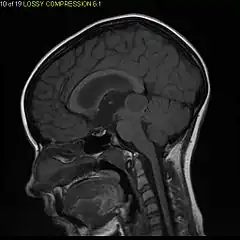 Sagittal T1-weighted MRI showing a well-circumscribed hypointense mass in the tectum (presumably a tectal plate glioma).  These lesions are a distinct subset of pilocytic astrocytoma which present with hydrocephalus typically in 6 to 10 year-olds and are rarely progressive lesions. When imaging is characteristic, a biopsy is usually not performed because of the risks to adjacent structures, often shunting to relieve intracranial pressure is the only treatment required.