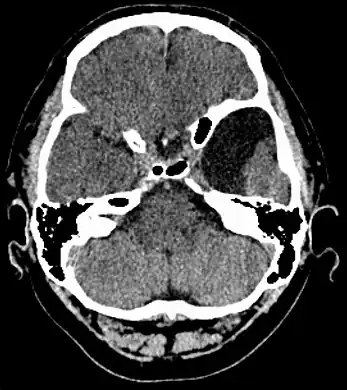 Axial CT showing a typical arachnoid cyst left temporal