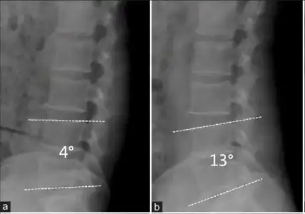 Individual with lumbar spinal stenosis (without spondylolisthesis)