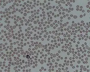 A picture of the blood under a microscope showing thrombocytopenia
