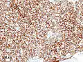 Histopathological image of thymoma type B1. Anterior mediastinal mass surgically resected. Cytokeratin CAM5.2 immunostain.