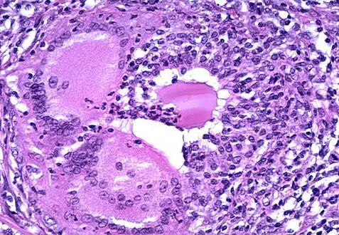 Microscopic image showing inflammation of the thyroid tissue