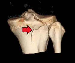 3D reconstruction of a CT image of a tibial plateau fracture