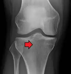 Subtle tibial plateau fracture on an AP X ray of the knee