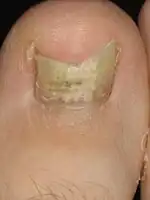 A case of fungal infection of the big toe