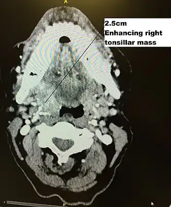 CT Scan of right tonsil cancer