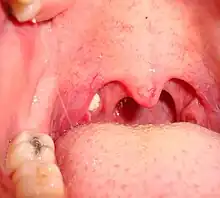 Large tonsillolith half exposed on tonsil