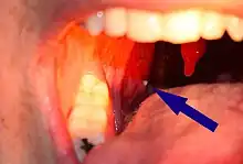A tonsillolith protrudes from the tonsil