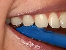Plastic wedge to identify pain on biting from a fractured tooth