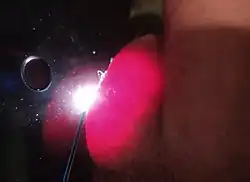 Epididymal cyst illuminated by a flashlight
