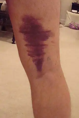 Bruising due to strained hamstring, horizontal lines show where bandage was.