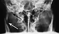 Towne's view of a bilateral condyle fracture.  White arrow is a fracture on the neck of the condyle.  Black arrow shows the condyle pulled to the medial.  The same injury can be seen on the opposite side