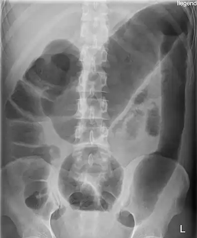 Toxic megacolon in a patient with ulcerative colitis: The patient subsequently underwent a colectomy.