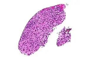 Brain biopsy-High magnification micrograph of toxoplasmosis