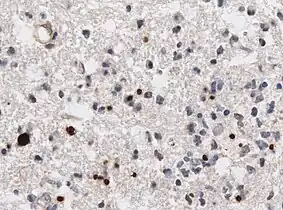 Immunohistochemistry displaying positive Toxoplasma gondii trophozoites in a brain biopsy of a HIV immunocompromised individual
