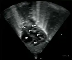Echocardiogram in transposition of the great arteries. This subcostal view shows the left ventricle giving rise to a vessel that bifurcates, which is thus identified as the pulmonary artery.Abbreviations: RA=right atrium, RV=right ventricle, LV=left ventricle, PT=pulmonary trunk, LPA and RPA=left and right pulmonary artery.