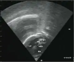 Echocardiography of a complex transposition with a ventricular septal defect and pulmonary stenosis.Abbreviations: LV and RV=left and right ventricle, PT=pulmonary trunk, VSD=ventricular septal defect, PS=pulmonary stenosis.