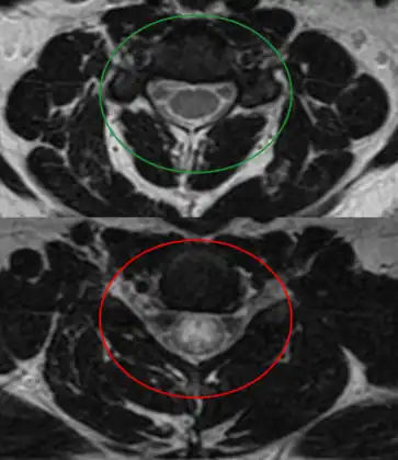 Axial T2 MRI of cervical spine demonstrating normal cord signal (green circle) and increased T2 signal in the central cord (red circle).