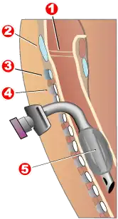 Diagram of a tracheostomy tube in the trachea