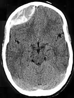 Non-contrast CT scan of a traumatic acute hematoma in the left fronto-temporal area.