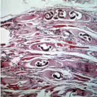 Trichinella spiralis larvae in muscle tissue