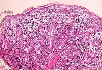 Small intestine biopsy of a patient with THE syndrome showing severe villous atrophy with intense mononuclear cell infiltration in the lamina propria. (Courtesy of Prof. Michel Peuchmaur, Hôpital Robert Debré, Paris, France)