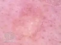 Trichoepithelioma (demoscopy)