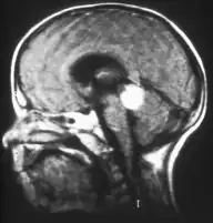 Aspect of trilateral retinoblastoma on MRI