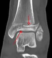 A triplane fracture of the ankle as seen on CT