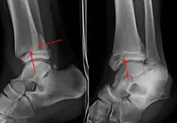 A triplane fracture of the ankle as seen on plain X-ray