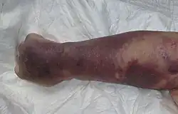 Right upper limb with purpura caused by thrombocytopenia in person with septic shock