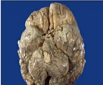 Tuberculous-meningitis-autopsy, showing associated brain oedema and congestion