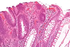 Micrograph of a tubular adenoma, the most common type of dysplastic polyp in the colon.