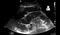 Small bowel obstruction on ultrasound.