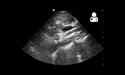 Ultrasound showing SMA syndrome