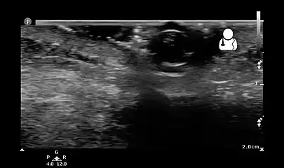 Ultrasound showing maggot infestation