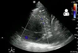 Pleural empyema as seen on ultrasound
