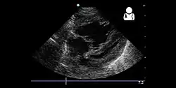 4 month old with pulmonary hypertension as seen on ultrasound