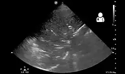 Pneumonia seen by ultrasound