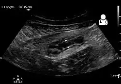 Ultrasound showing appendicitis and an appendicolith