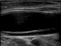 Dissection of the carotid artery on ultrasound