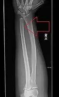 Undisplaced isolated ulna fracture