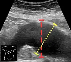 Ultrasonography in the sagittal plane, showing axial plane measure (dashed red line), as well as maximal diameter (dotted yellow line) which is preferred.