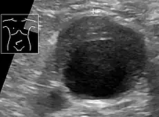 Ultrasonography of an aneurysm with a mural thrombus.