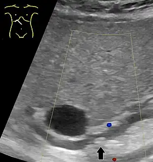 Abdominal ultrasonography of a common bile duct stone