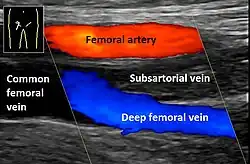 Doppler ultrasonography showing absence of flow and hyperechogenic content in a clotted femoral vein (labeled subsartorial) distal to the branching point of the deep femoral vein.  When compared to this clot, clots that instead obstruct the common femoral vein cause more severe effects due to impacting a significantly larger portion of the leg.