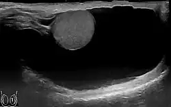 Scrotal ultrasound of a 10 cm large hydrocele, with anechoic (dark) fluid surrounding the testicle.