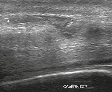 Figure 4 A: Ultrasound of the penis, right lateral view. Longitudinal section showing rupture of the tunica albuginea with an adjacent 1.92 cm hematoma (between calipers), due to trauma.